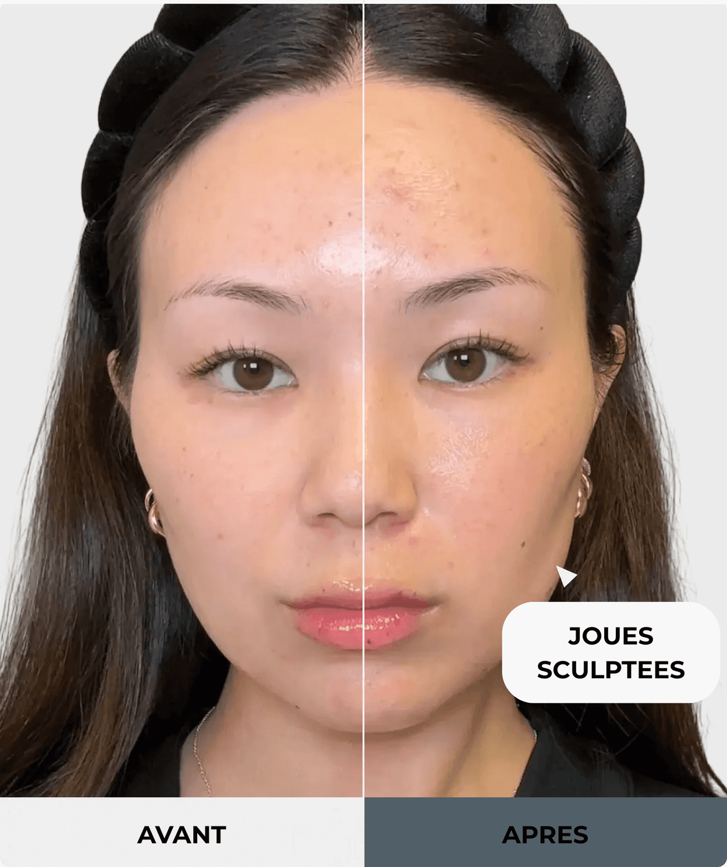 Image avant/après montrant une jeune femme. Côté "Avant" : le visage est plein et les joues moins définies. Côté "Après" : une ligne de contour plus définie apparaît au niveau de la joue, indiquant un effet amincissant et sculptant. Une flèche pointe vers la joue et le texte "JOUES SCULPTÉES" est visible. Ce résultat est obtenu avec le produit Nanosculpt.