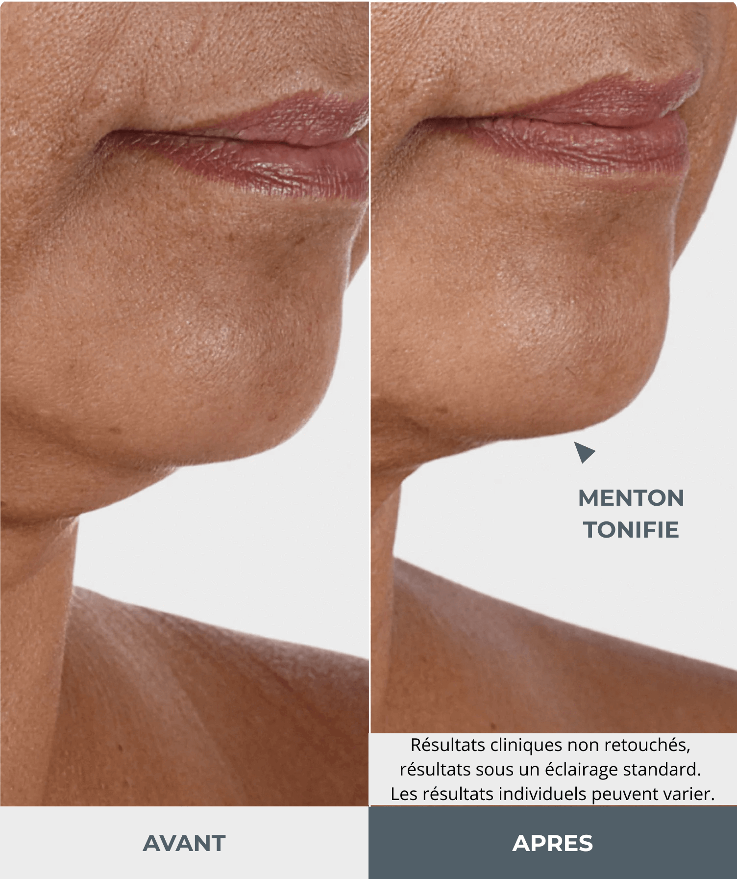 Image avant/après montrant la zone du menton et du cou d'une personne d'âge mûr. Côté "Avant" : la peau sous le menton présente des signes de relâchement et de ridules. Côté "Après" : la zone du menton et de la mâchoire est visiblement plus ferme et tonifiée, avec moins de relâchement cutané. Une flèche pointe vers le menton et le texte "MENTON TONIFIÉ" est affiché. a